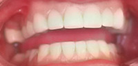 Perfect Smile full contour teeth
